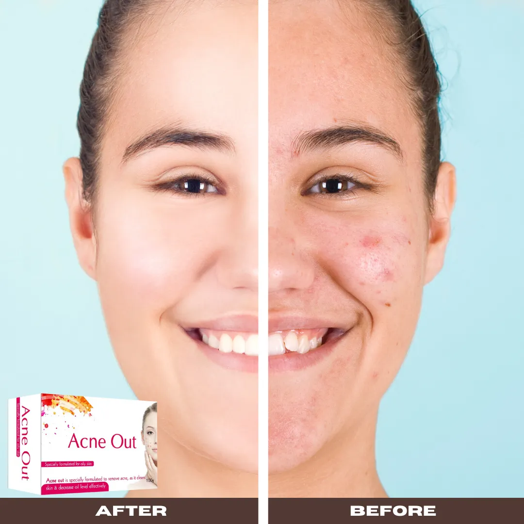 Nourish & Flourish Acne Out Soap - Anti Acne Soap for Oily Skin
