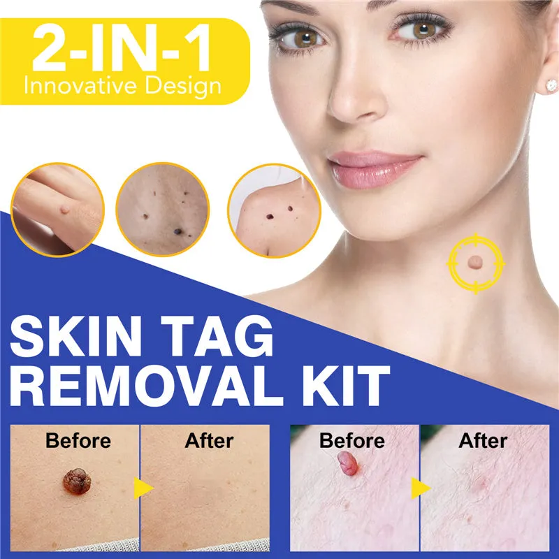 Wart or Skin Tag Remover Kit