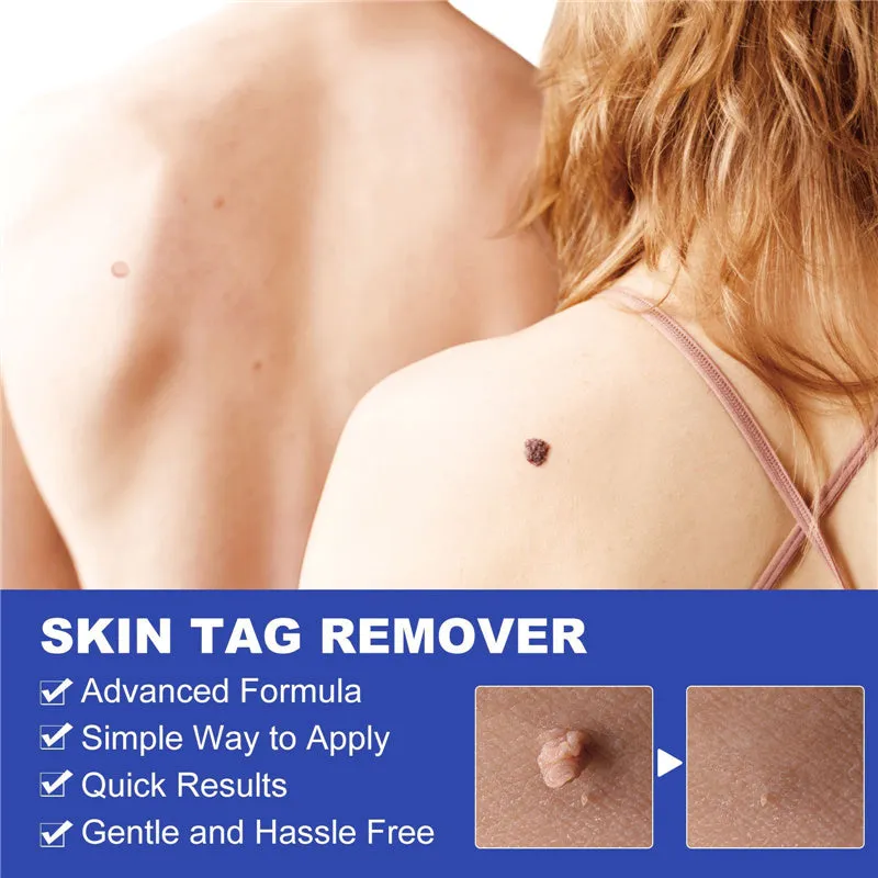 Wart or Skin Tag Remover Kit