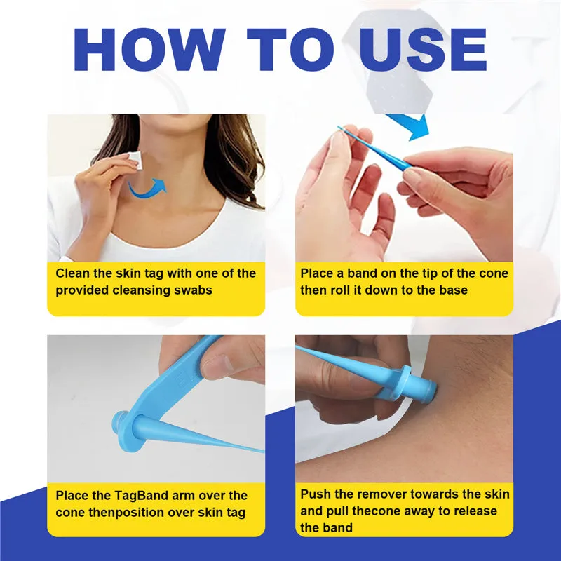 Wart or Skin Tag Remover Kit